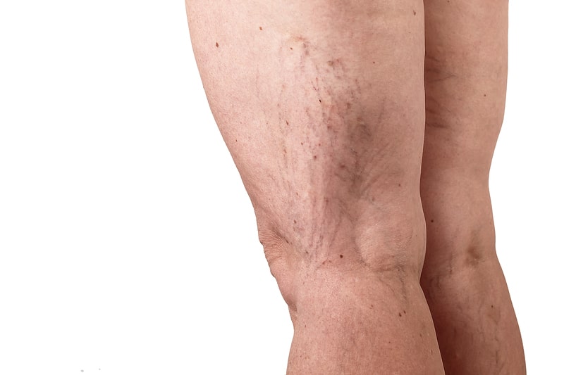 doenca vascular periferica  pernas com manchas