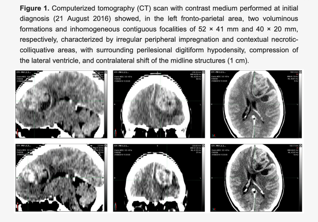 Exame de imagem mostra tumor no cérebro da paciente