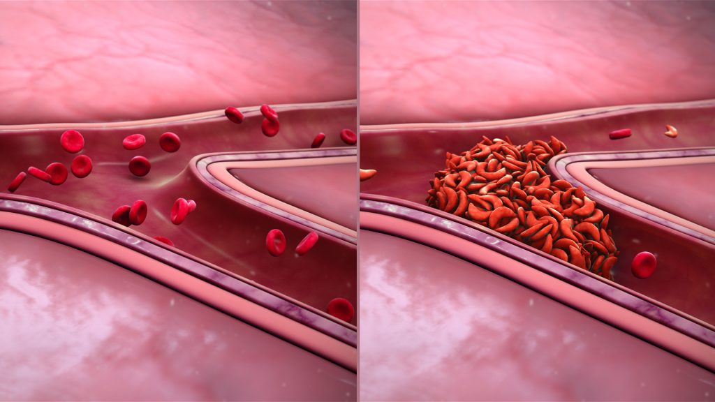 imagem que mostra vaso sanguíneo funcionando regularmente e outro obstruído por células vermelhas no formato de foice