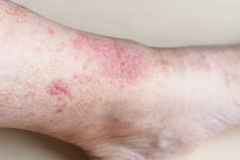 eczema tratamento feridas
