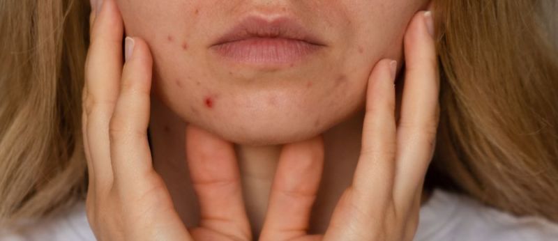 CBD e possibilidades no tratamento da acne