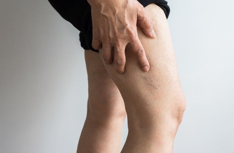 doenca vascular periferica varizes na perna